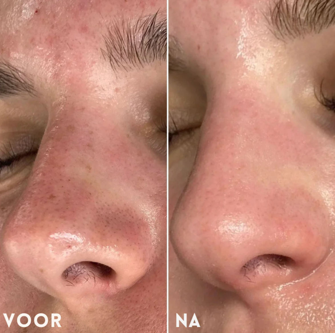 Mivona™ | Pore Perfect