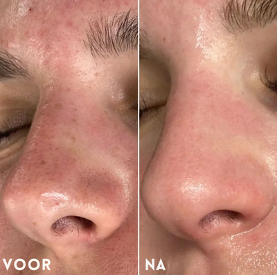 Mivona™ | Pore Perfect