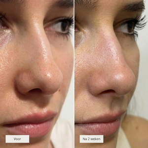 Mivona™ | Nose Patches
