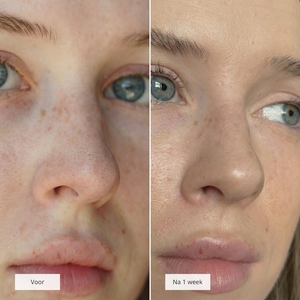 Mivona™ | Nose Patches